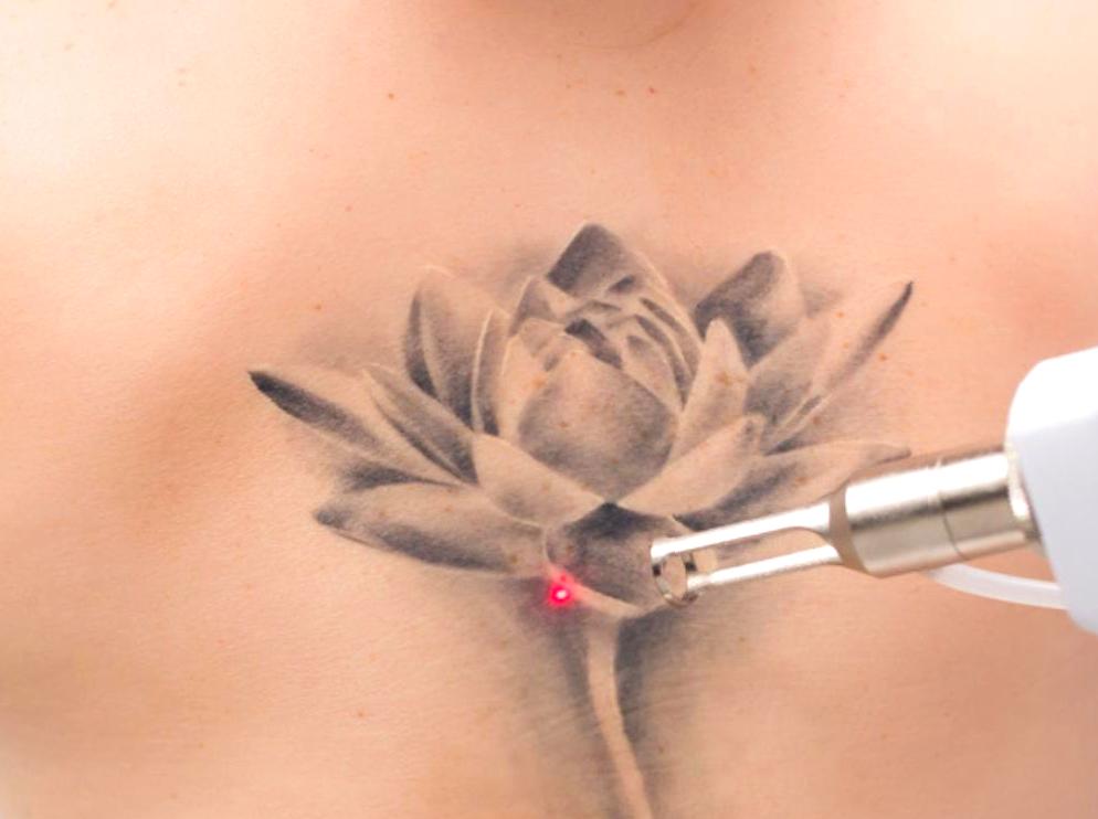 Post-Laser Tattoo Removal Care Guidelines