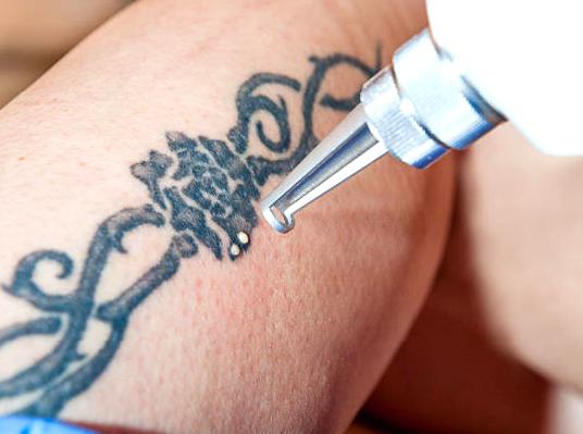 Essential Aftercare Steps Following Laser Tattoo Removal