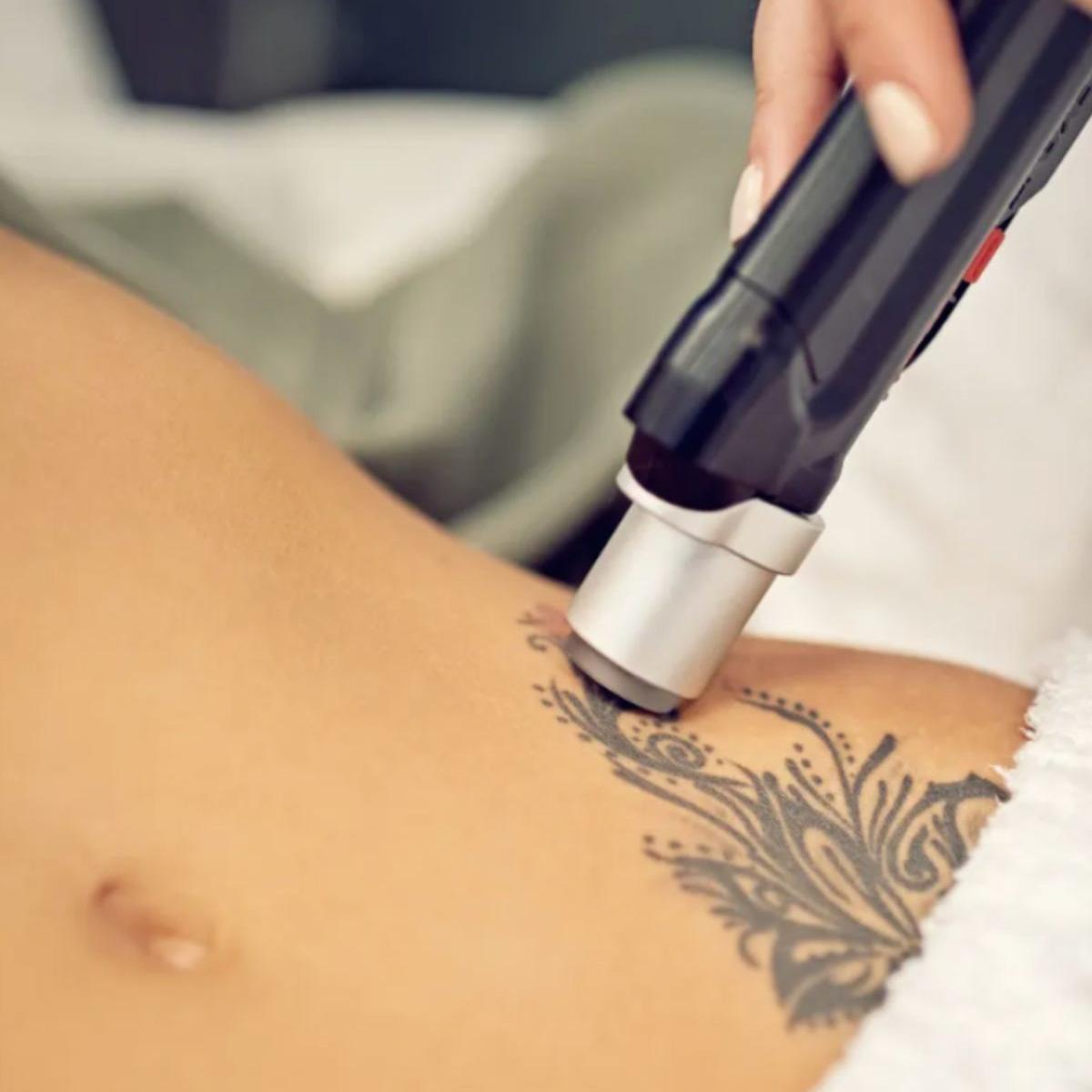 How painful is tattoo removal?