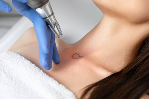 Does tattoo removal hurt significantly?