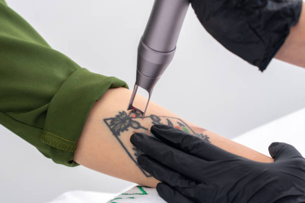 How Tattoo Removal Operates