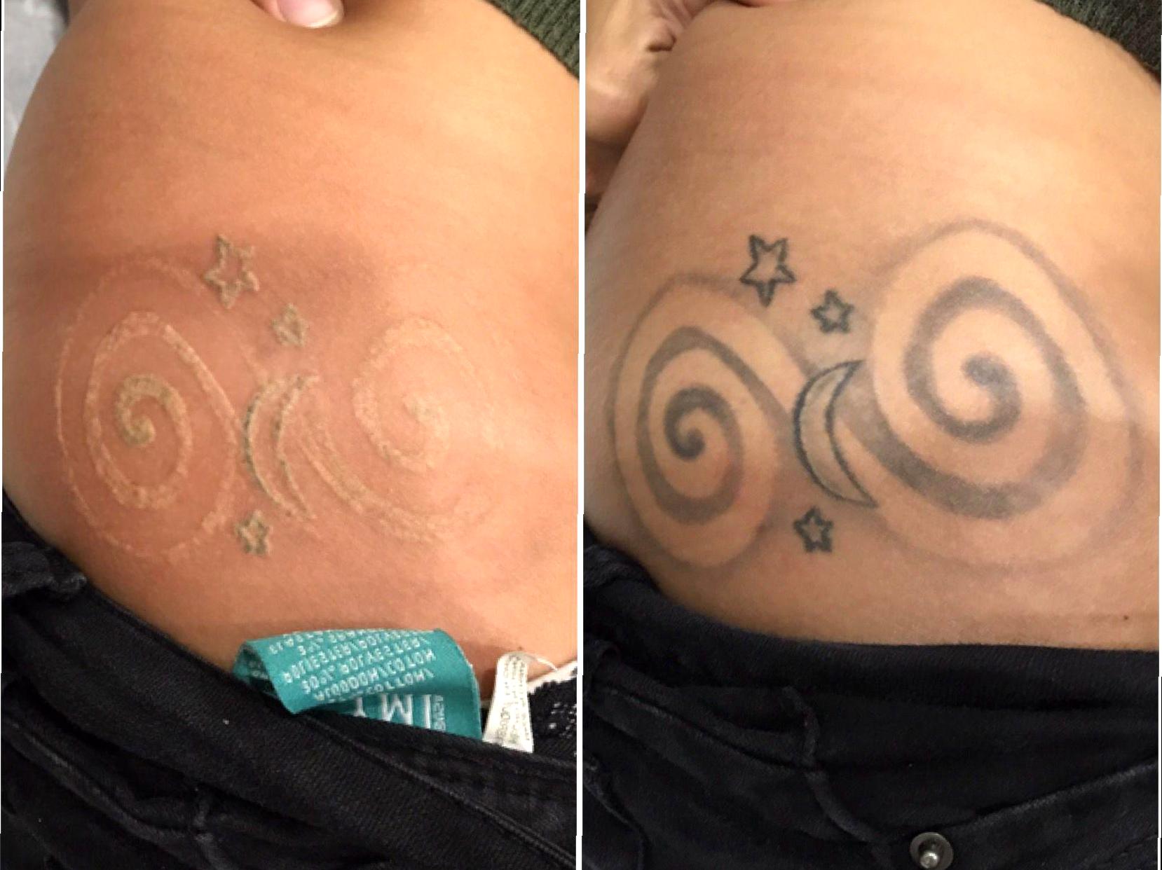 Strategies to Minimize Scars After Tattoo Removal