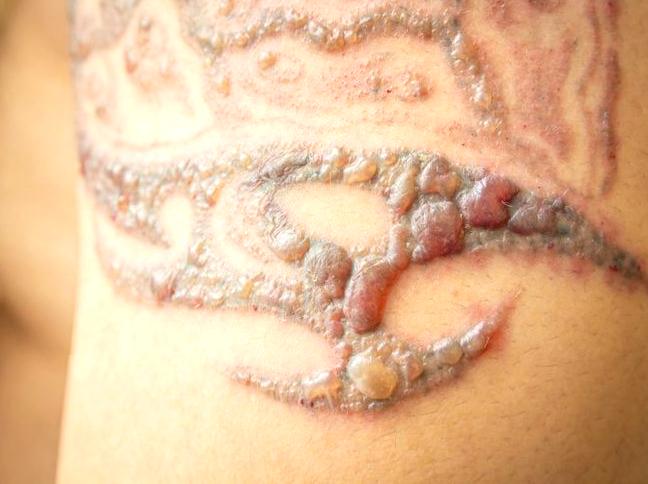 Effective Methods for Scar Minimization in Tattoo Removal